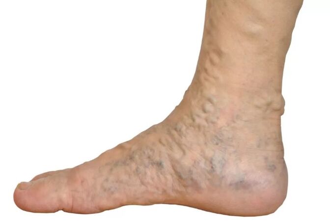 Veens le malattie sulle gambe