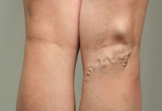 Malattia vena
