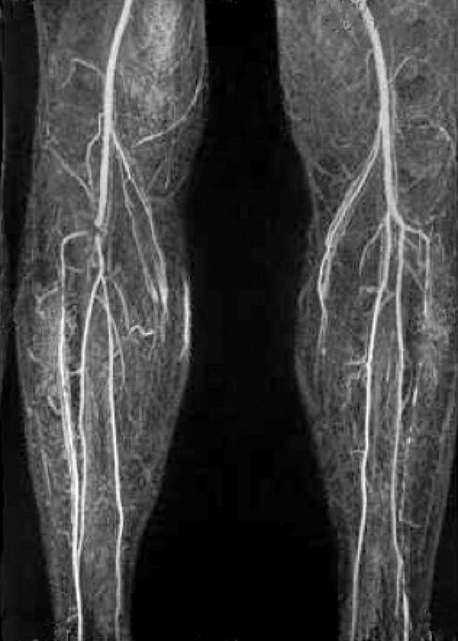 Vessel X -Ray