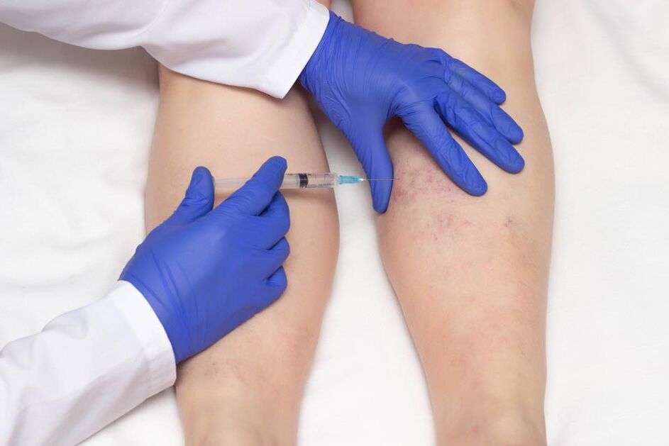 La scleroterapia è un metodo per trattare le vene varicose
