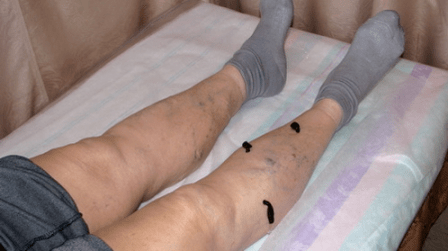 Trattare le vene varicose con le sanguisughe