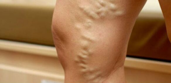 Vene varicose sulle gambe delle donne