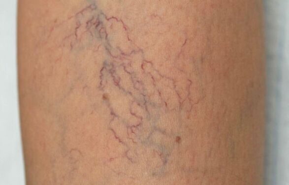 Vene varicose sulle gambe nelle donne