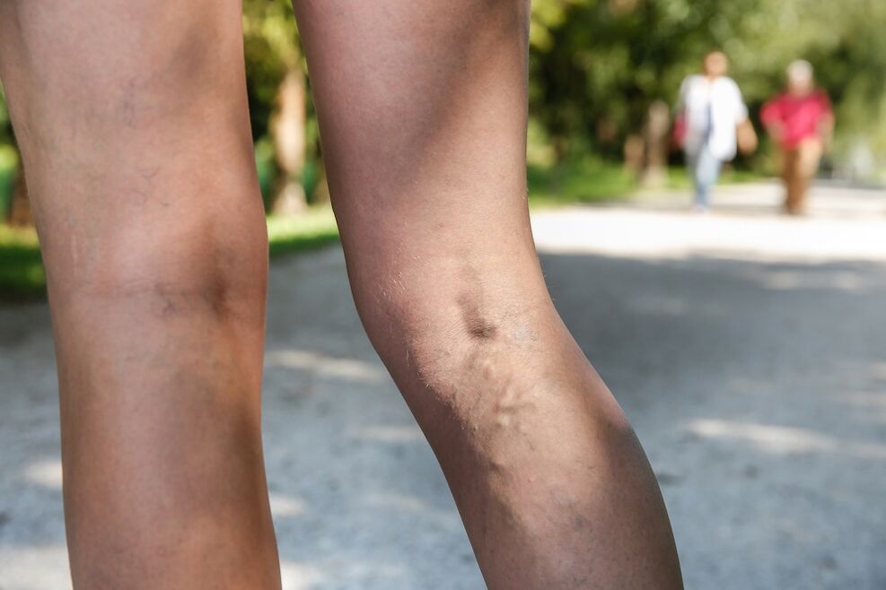 Vene varicose sulle gambe