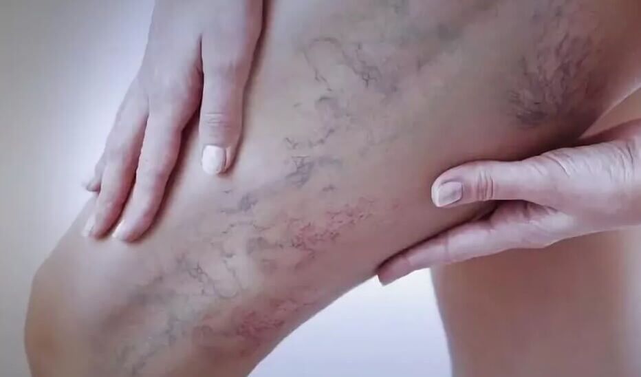 Stelle sulle gambe con vene varicose