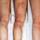 Vene varicose delle gambe