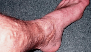 Cause delle vene varicose sulle gambe negli uomini