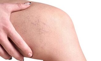 Fasi di sviluppo delle vene varicose