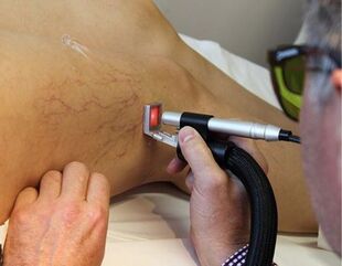 Controindicazioni al trattamento delle vene varicose con un laser