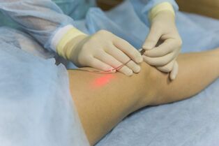 Il trattamento laser delle vene varicose è l'essenza della procedura
