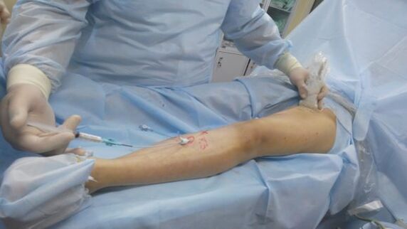 Chirurgia per le vene varicose alle gambe