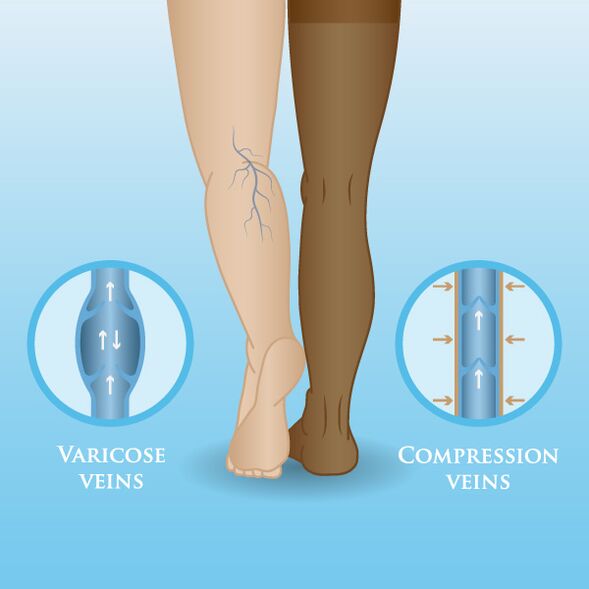 Effetti degli indumenti compressivi sulle vene varicose delle gambe