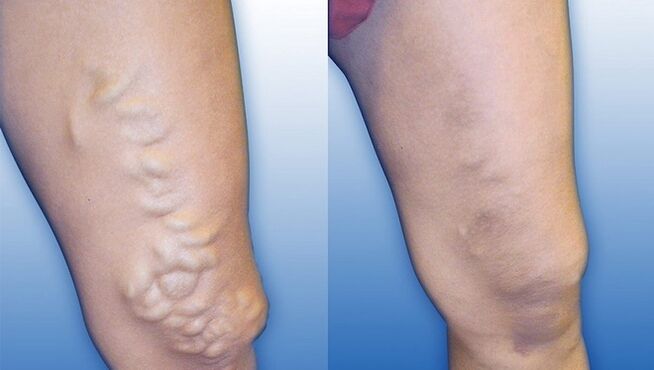 Gambe prima e dopo il trattamento grave delle vene varicose