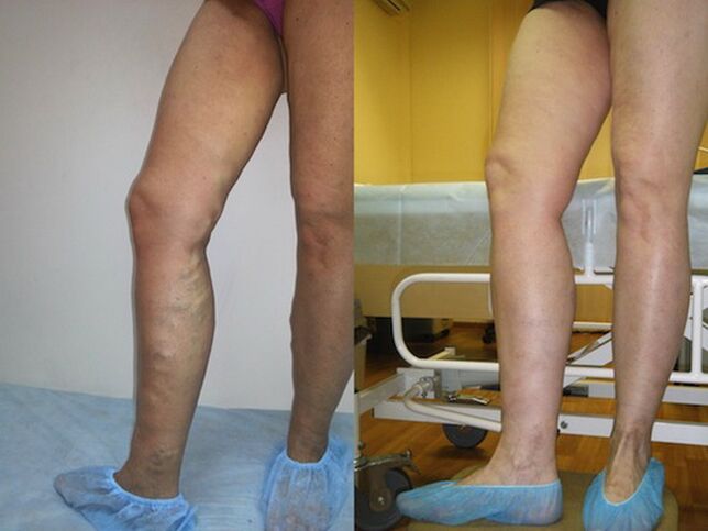 Gambe prima e dopo trattamento laser vene varicose